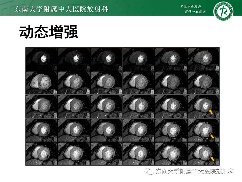影像PPT - 【病例】法布雷病4例MR-31 影像PPT - 【病例】法布雷病4例MR-31