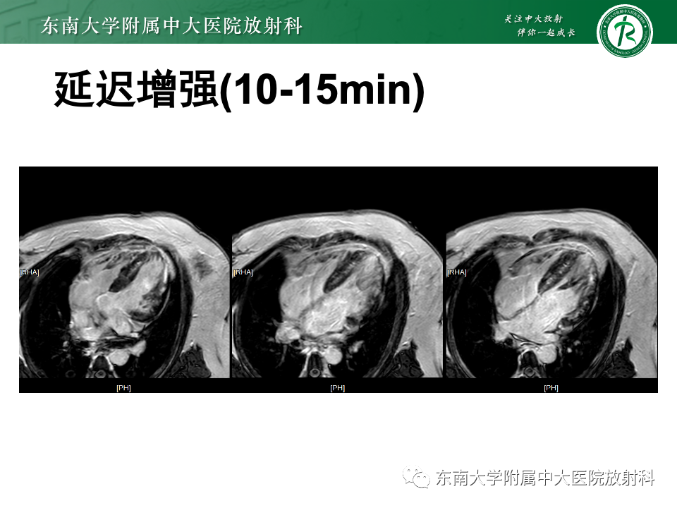 影像PPT - 【病例】法布雷病4例MR-33 影像PPT - 【病例】法布雷病4例MR-33