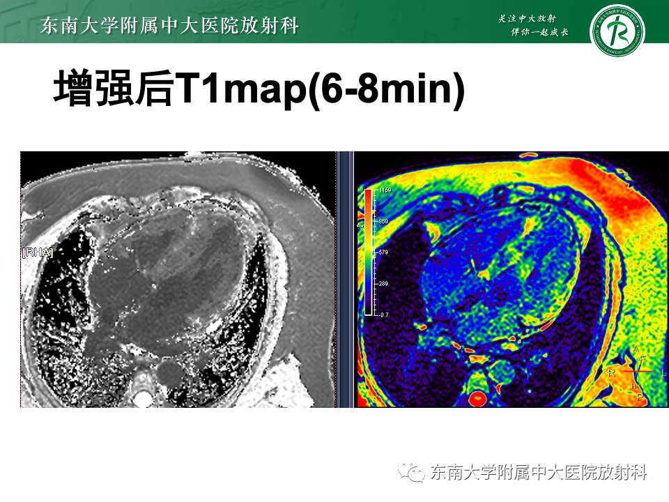 影像PPT - 【病例】法布雷病4例MR-32 影像PPT - 【病例】法布雷病4例MR-32