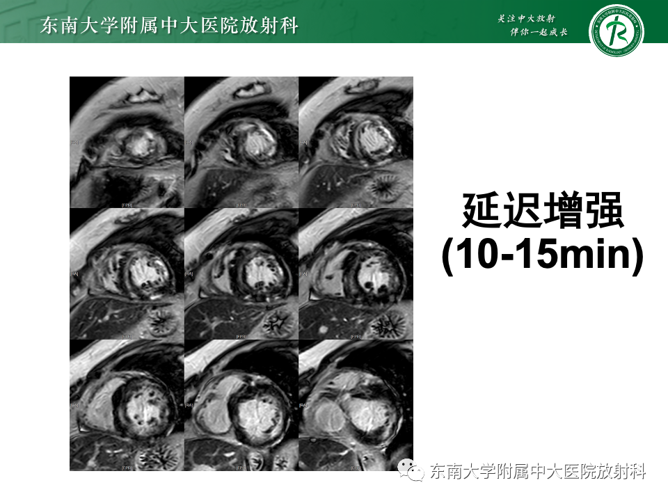影像PPT - 【病例】法布雷病4例MR-34 影像PPT - 【病例】法布雷病4例MR-34