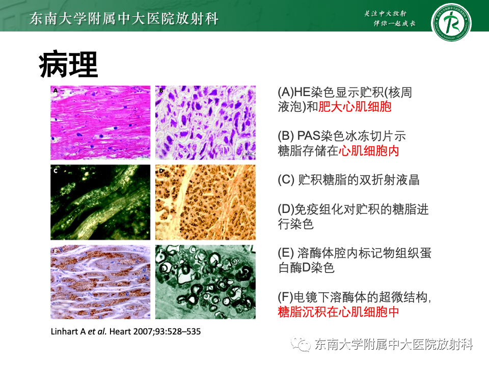影像PPT - 【病例】法布雷病4例MR-42 影像PPT - 【病例】法布雷病4例MR-42