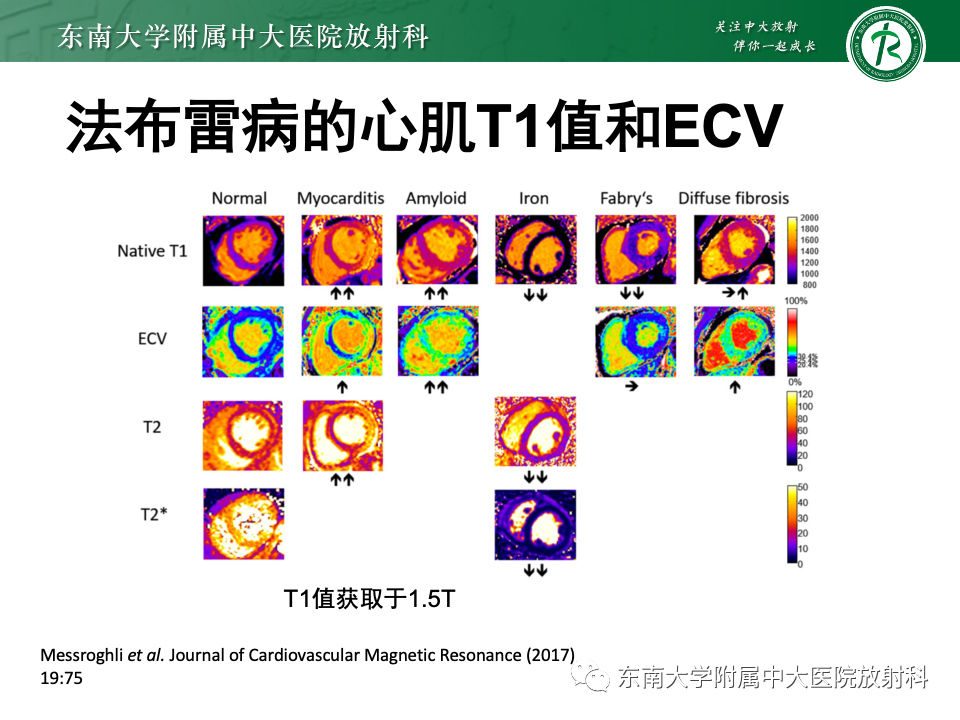 影像PPT - 【病例】法布雷病4例MR-46 影像PPT - 【病例】法布雷病4例MR-46