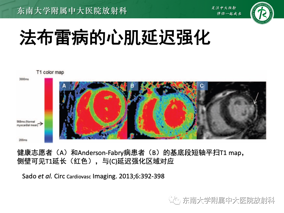 影像PPT - 【病例】法布雷病4例MR-47 影像PPT - 【病例】法布雷病4例MR-47
