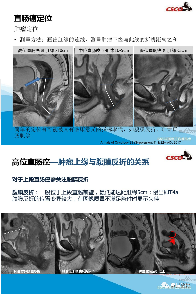 影像PPT - 直肠癌MRI解剖、扫描规范、影像学评价、结构式报告-4