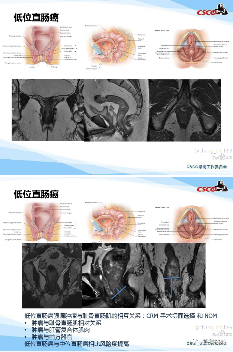 影像PPT - 直肠癌MRI解剖、扫描规范、影像学评价、结构式报告-6