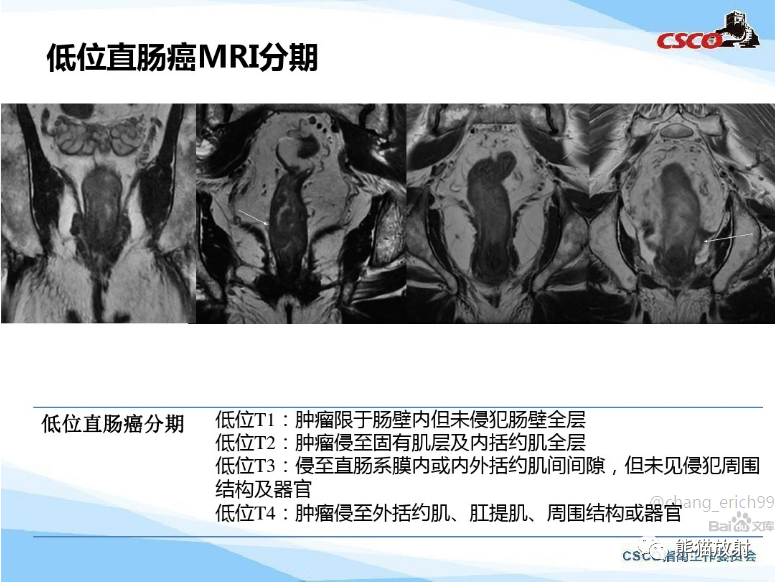 影像PPT - 直肠癌MRI解剖、扫描规范、影像学评价、结构式报告-7