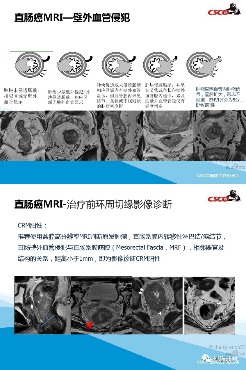 影像PPT - 直肠癌MRI解剖、扫描规范、影像学评价、结构式报告-10