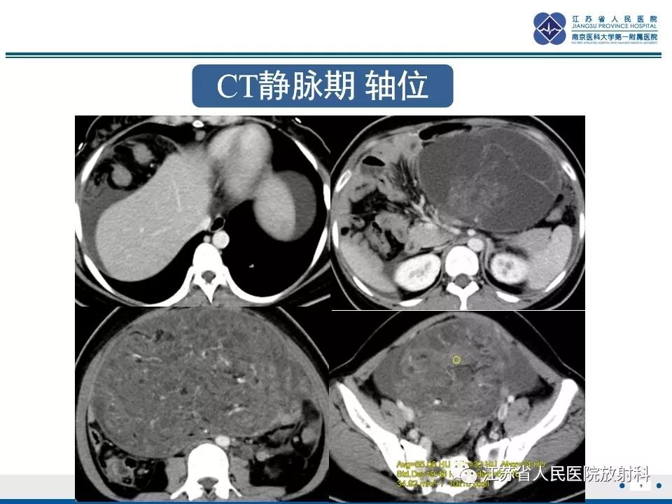 影像PPT - 【PPT】不成熟性畸胎瘤-6