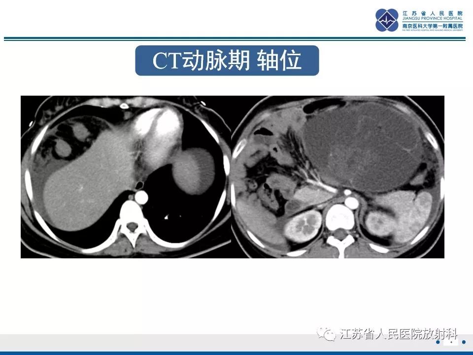 影像PPT - 【PPT】不成熟性畸胎瘤-5