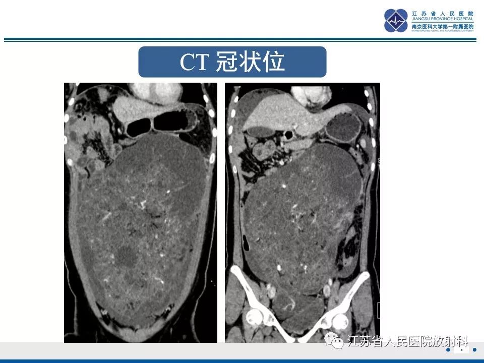 影像PPT - 【PPT】不成熟性畸胎瘤-7