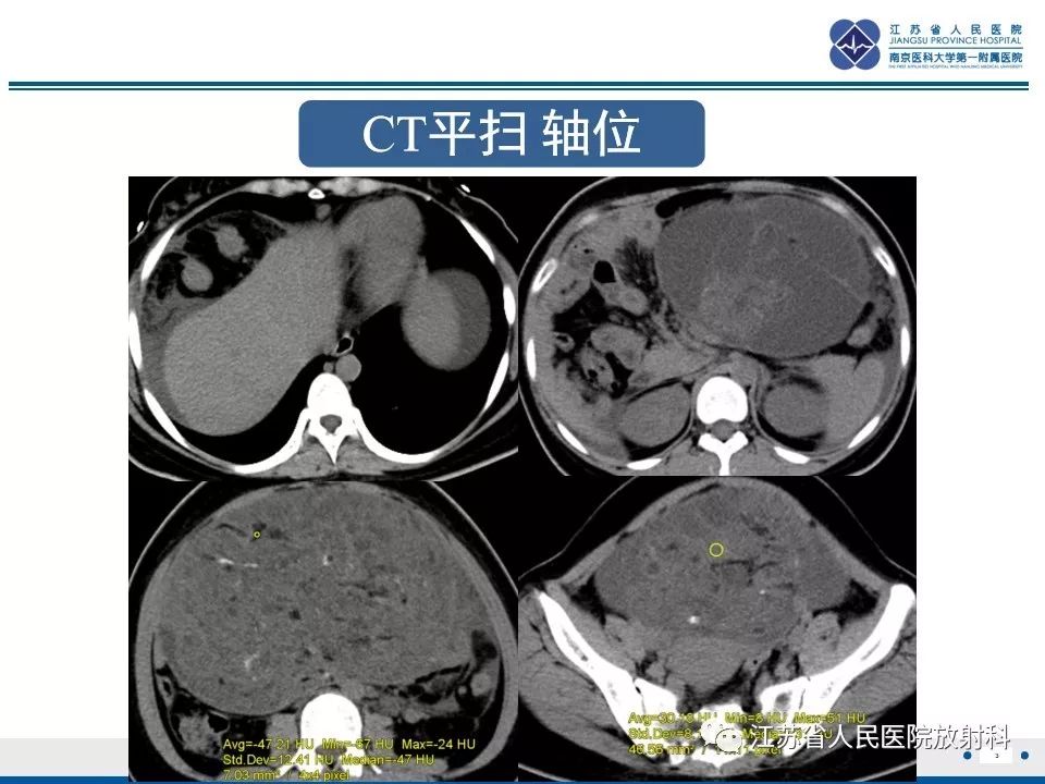 影像PPT - 【PPT】不成熟性畸胎瘤-4