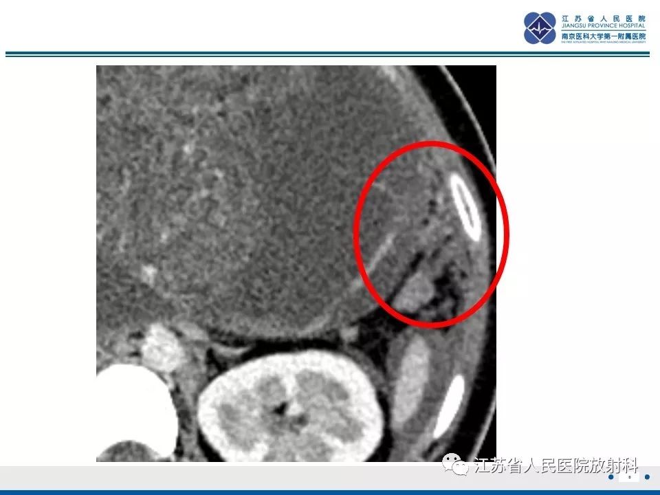 影像PPT - 【PPT】不成熟性畸胎瘤-9