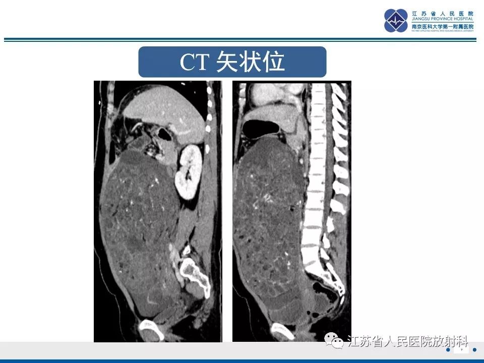 影像PPT - 【PPT】不成熟性畸胎瘤-8
