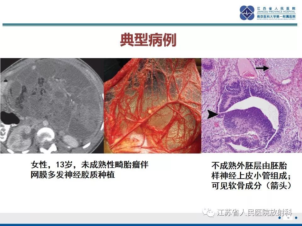 影像PPT - 【PPT】不成熟性畸胎瘤-19