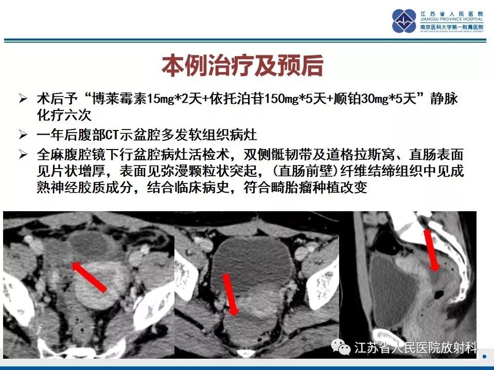 影像PPT - 【PPT】不成熟性畸胎瘤-26