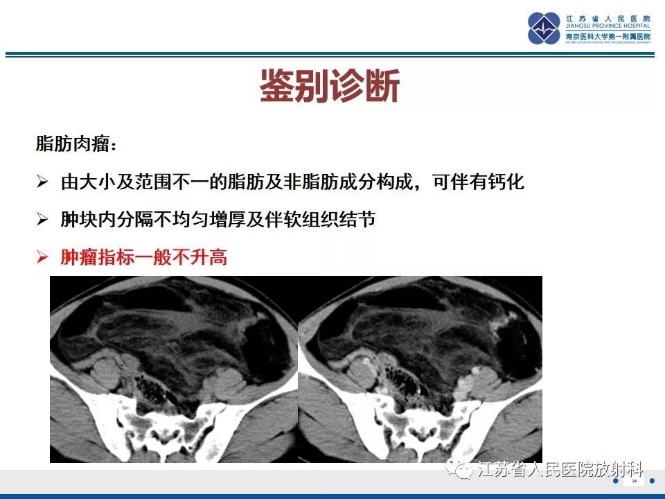 影像PPT - 【PPT】不成熟性畸胎瘤-28