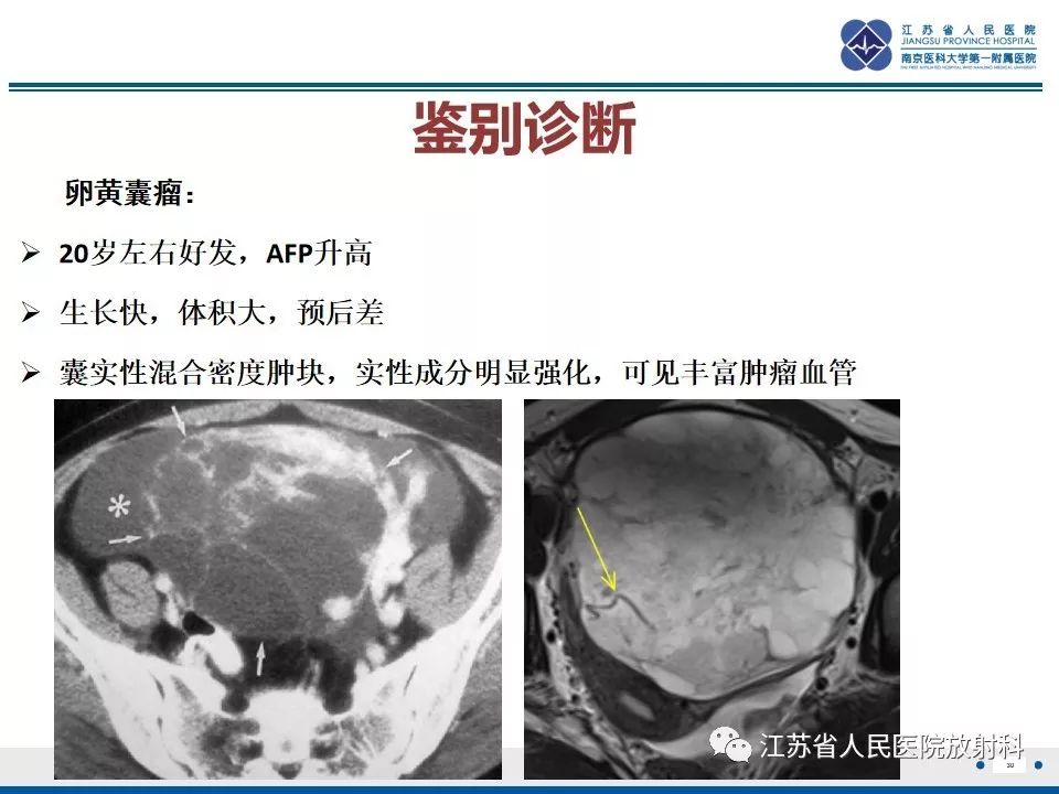 影像PPT - 【PPT】不成熟性畸胎瘤-30