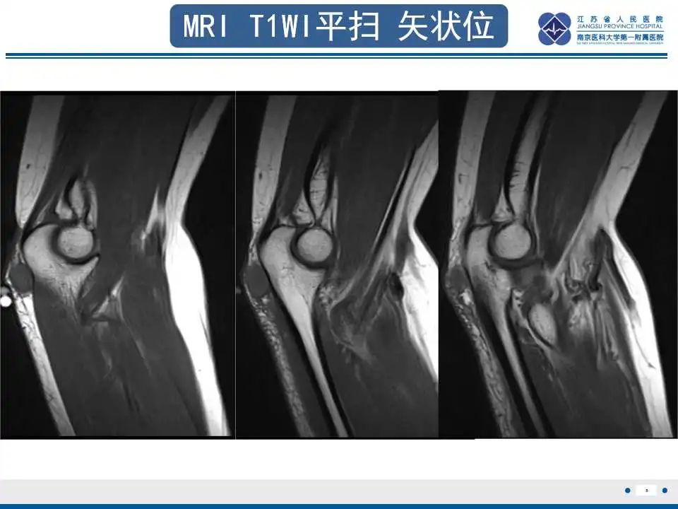 影像PPT - 【PPT】结节性筋膜炎-6