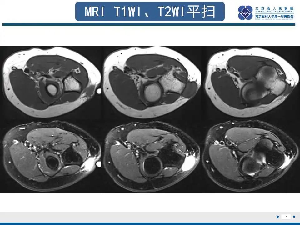 影像PPT - 【PPT】结节性筋膜炎-5
