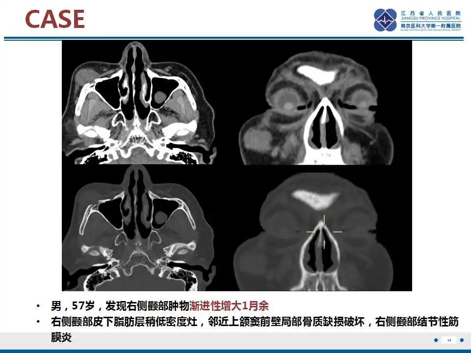 影像PPT - 【PPT】结节性筋膜炎-29