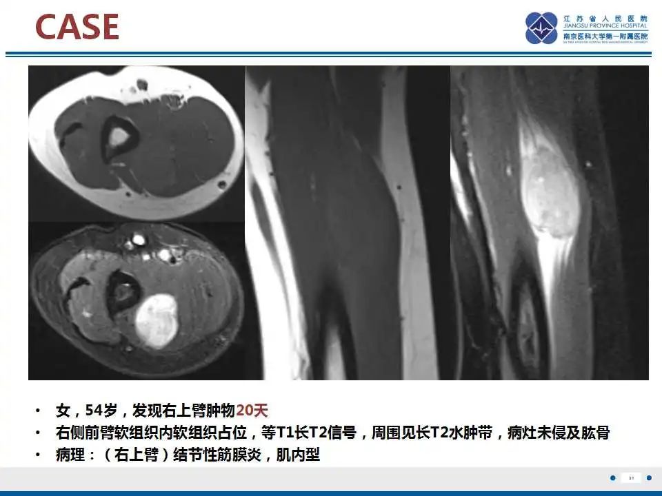 影像PPT - 【PPT】结节性筋膜炎-32
