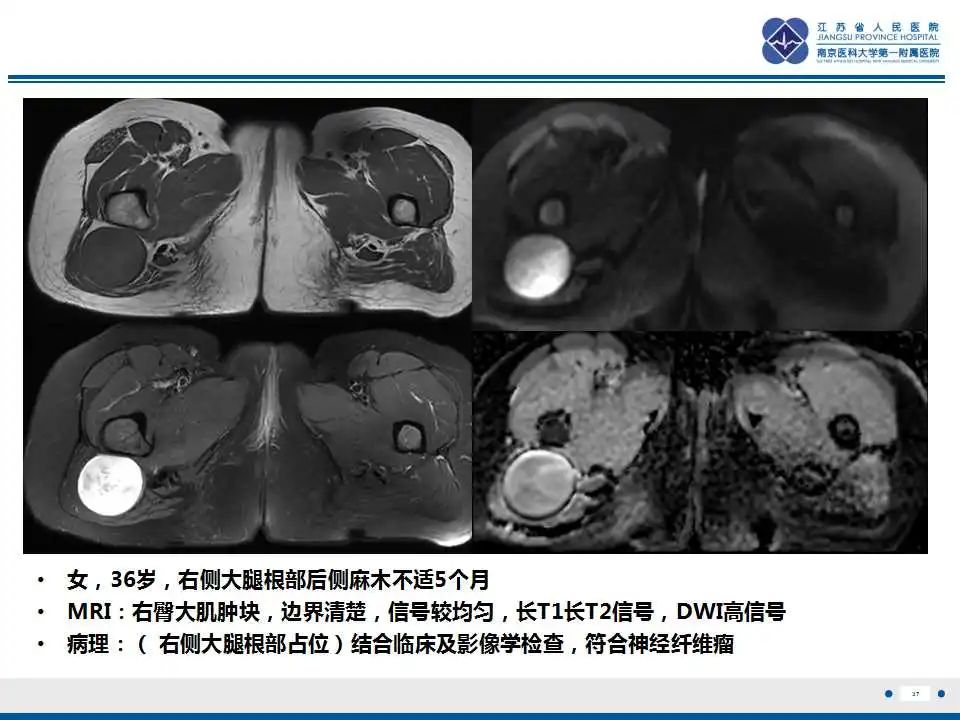 影像PPT - 【PPT】结节性筋膜炎-38
