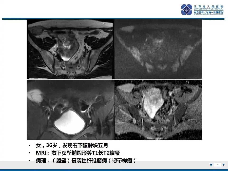 影像PPT - 【PPT】结节性筋膜炎-40