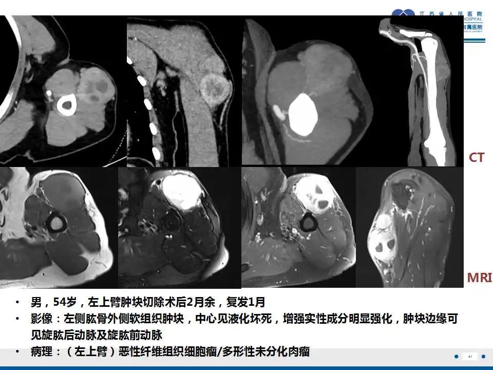 影像PPT - 【PPT】结节性筋膜炎-42