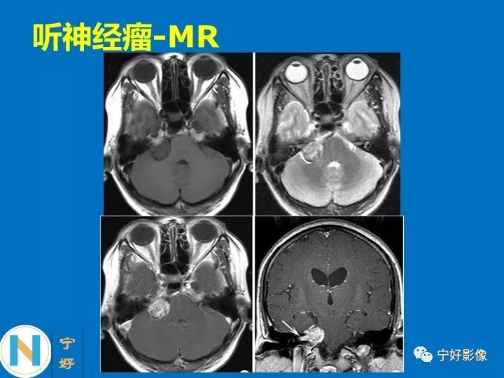 影像PPT - 【PPT】后颅窝常见肿瘤影像诊断与鉴别诊断-9