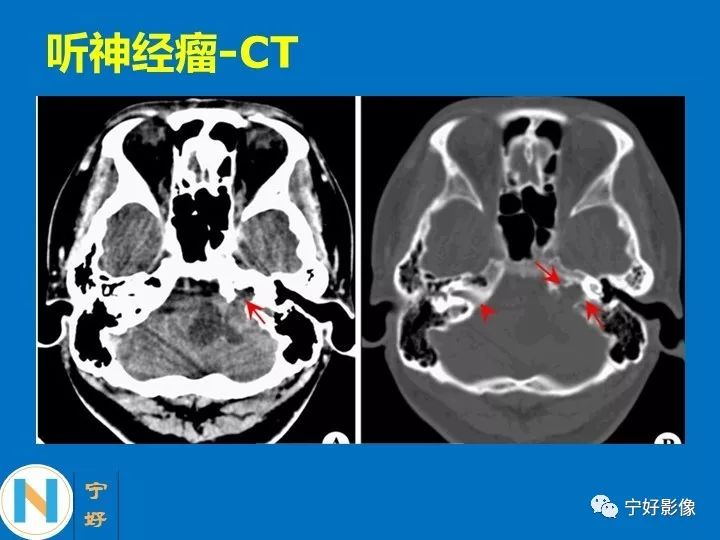 影像PPT - 【PPT】后颅窝常见肿瘤影像诊断与鉴别诊断-8