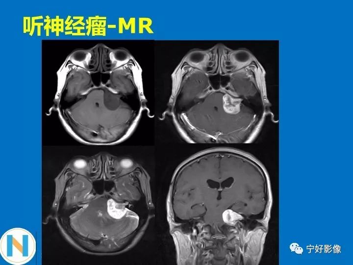 影像PPT - 【PPT】后颅窝常见肿瘤影像诊断与鉴别诊断-10