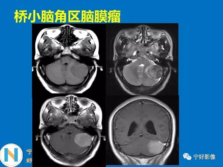影像PPT - 【PPT】后颅窝常见肿瘤影像诊断与鉴别诊断-14