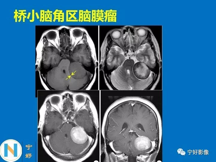 影像PPT - 【PPT】后颅窝常见肿瘤影像诊断与鉴别诊断-13