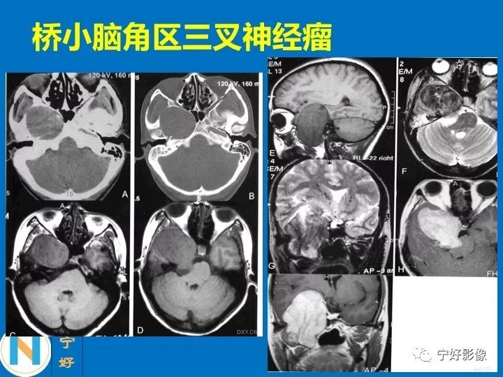 影像PPT - 【PPT】后颅窝常见肿瘤影像诊断与鉴别诊断-19