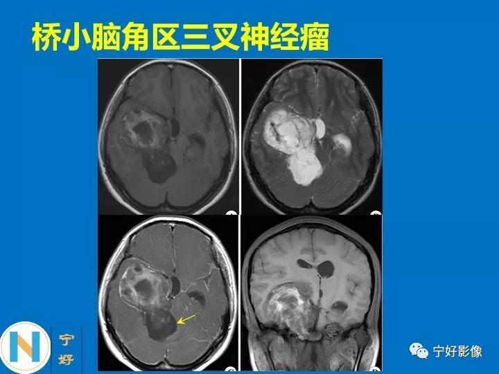 影像PPT - 【PPT】后颅窝常见肿瘤影像诊断与鉴别诊断-18