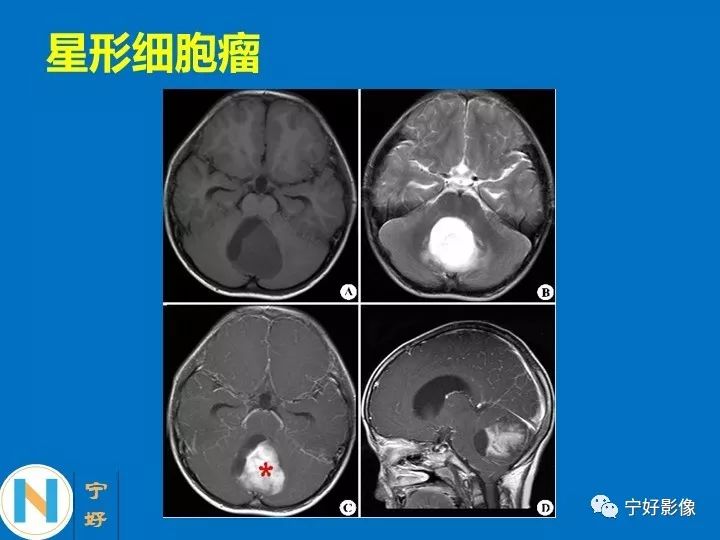 影像PPT - 【PPT】后颅窝常见肿瘤影像诊断与鉴别诊断-26