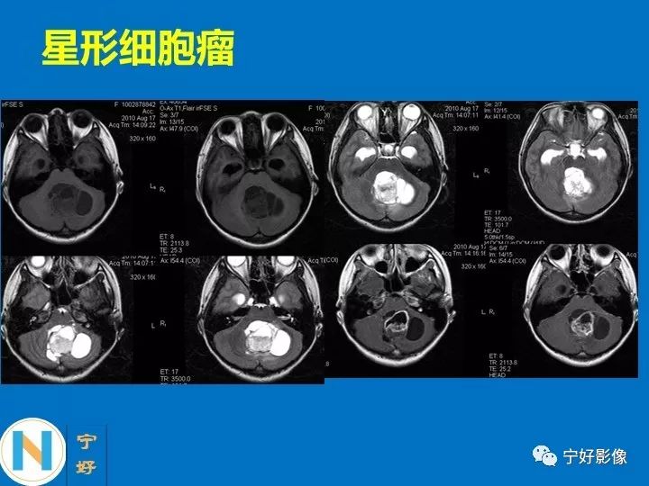 影像PPT - 【PPT】后颅窝常见肿瘤影像诊断与鉴别诊断-27