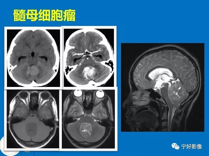 影像PPT - 【PPT】后颅窝常见肿瘤影像诊断与鉴别诊断-30