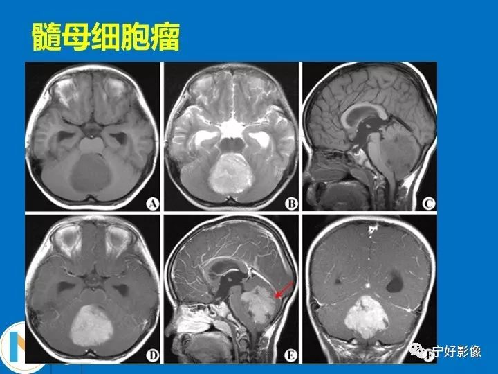 影像PPT - 【PPT】后颅窝常见肿瘤影像诊断与鉴别诊断-31