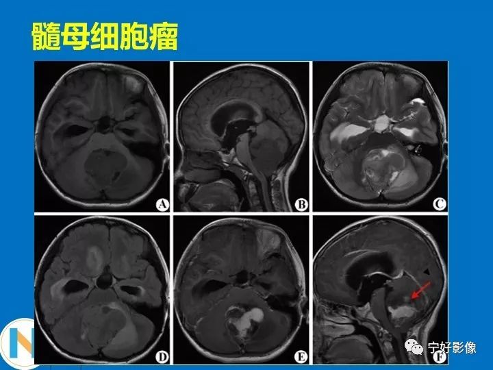 影像PPT - 【PPT】后颅窝常见肿瘤影像诊断与鉴别诊断-32