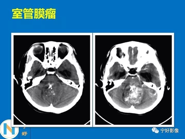影像PPT - 【PPT】后颅窝常见肿瘤影像诊断与鉴别诊断-35