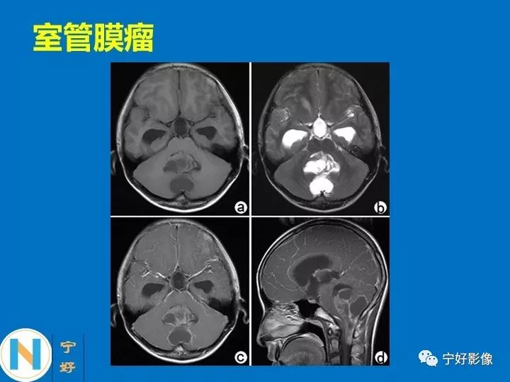 影像PPT - 【PPT】后颅窝常见肿瘤影像诊断与鉴别诊断-36