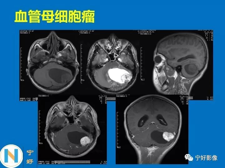 影像PPT - 【PPT】后颅窝常见肿瘤影像诊断与鉴别诊断-39