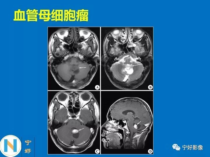 影像PPT - 【PPT】后颅窝常见肿瘤影像诊断与鉴别诊断-40