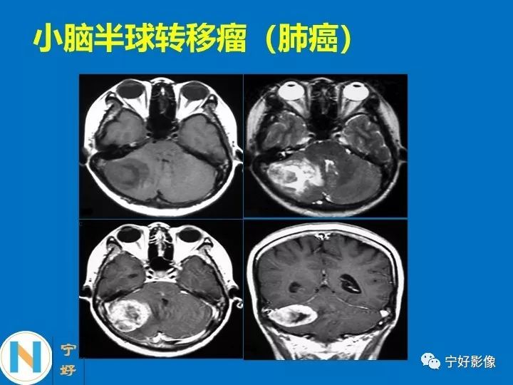 影像PPT - 【PPT】后颅窝常见肿瘤影像诊断与鉴别诊断-43