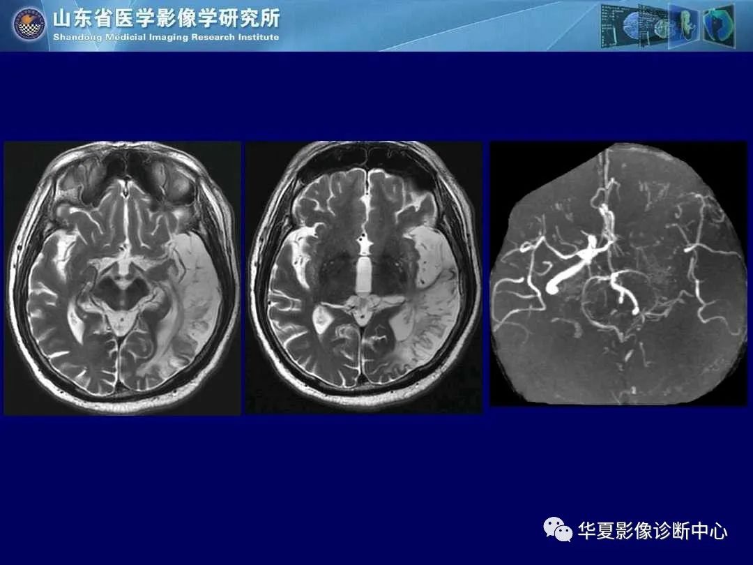 影像PPT - 【PPT】缺血性脑血管病的影像诊断-10