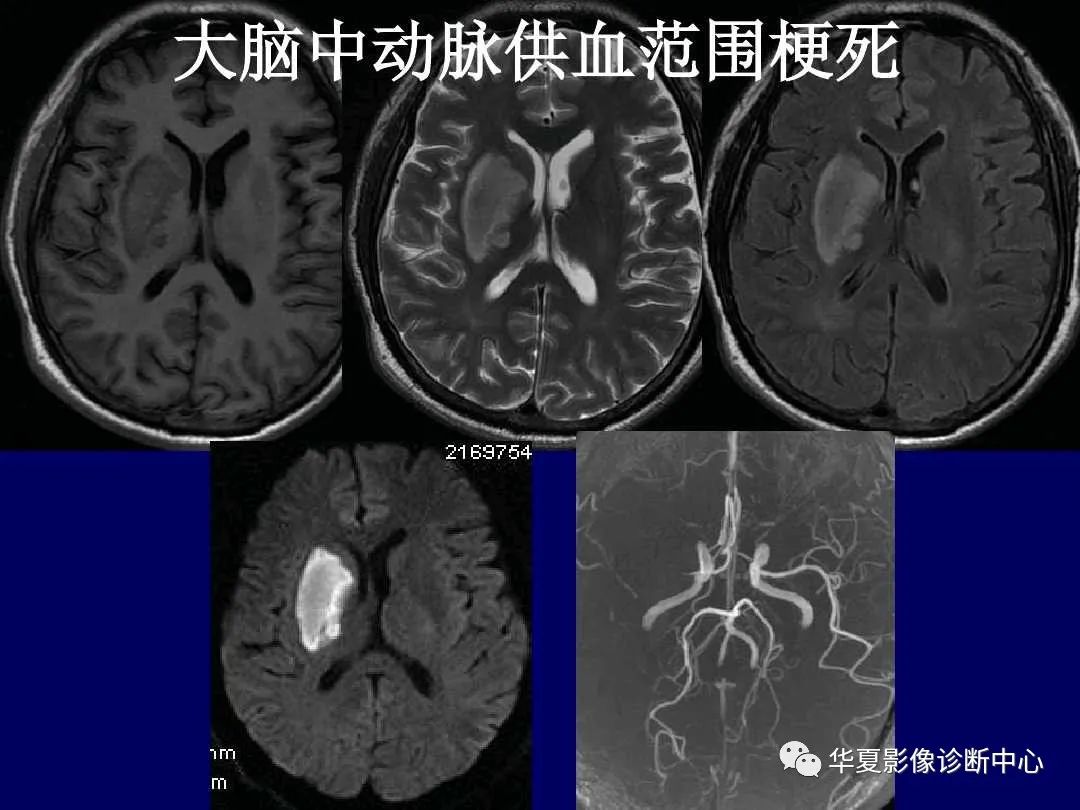 影像PPT - 【PPT】缺血性脑血管病的影像诊断-9