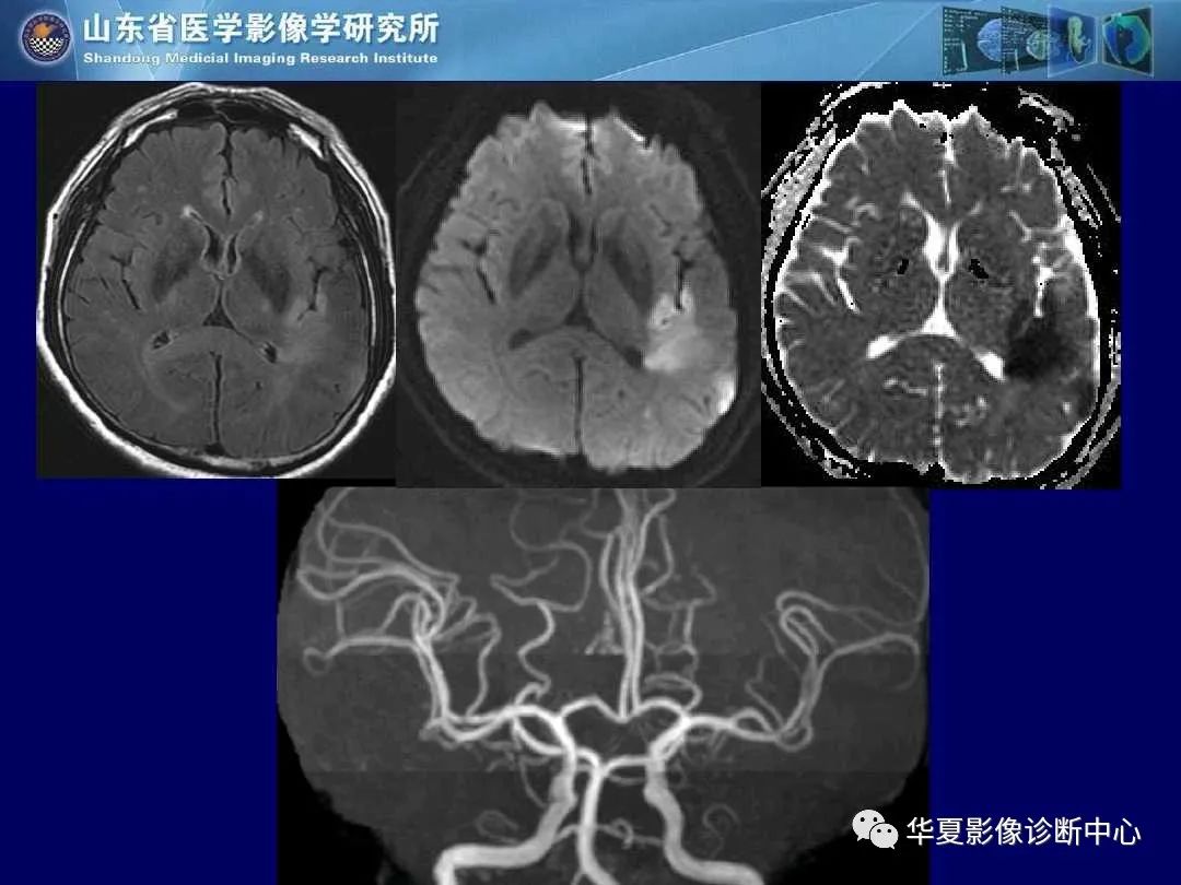 影像PPT - 【PPT】缺血性脑血管病的影像诊断-11
