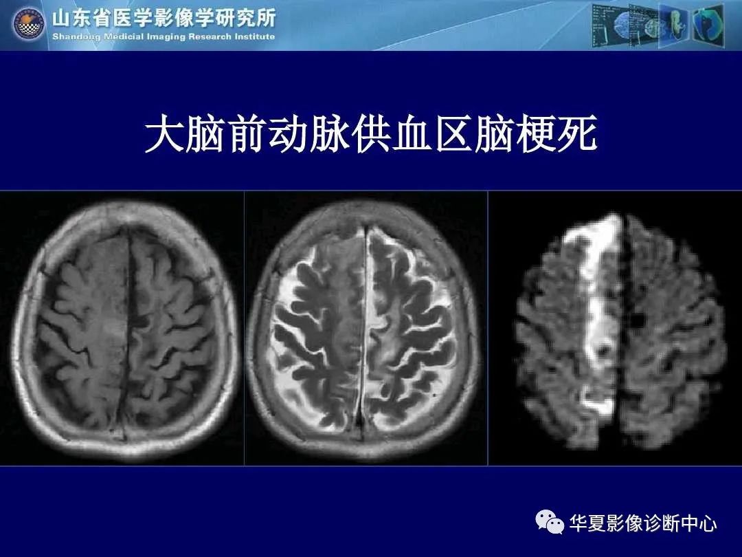 影像PPT - 【PPT】缺血性脑血管病的影像诊断-6