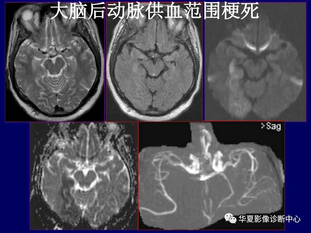 影像PPT - 【PPT】缺血性脑血管病的影像诊断-14
